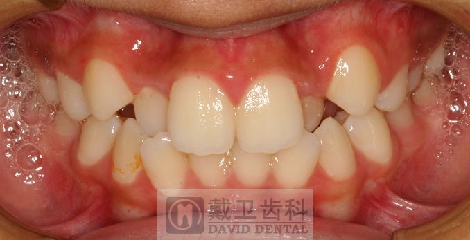 牙齿矫正患者1