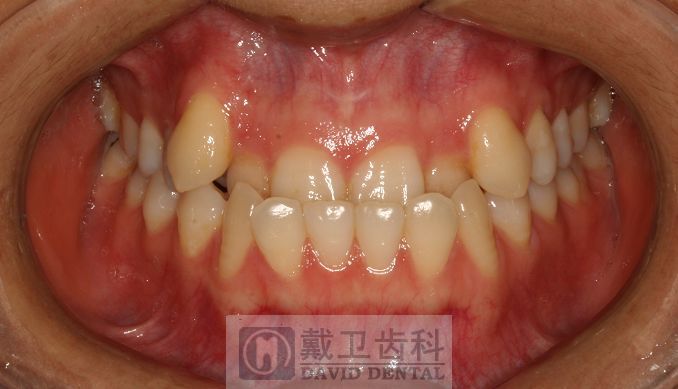 牙齿矫正患者2