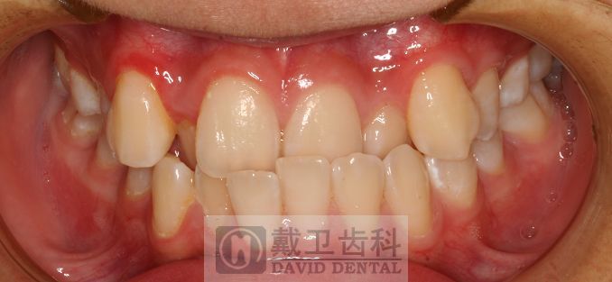 牙齿矫正患者3