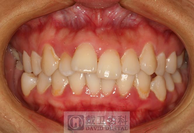 牙齿矫正患者6